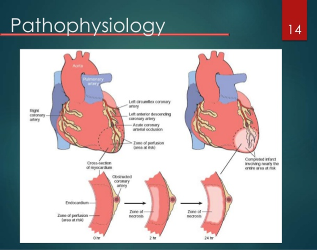 Myocardial Infarction