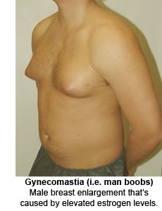 gynecomastia