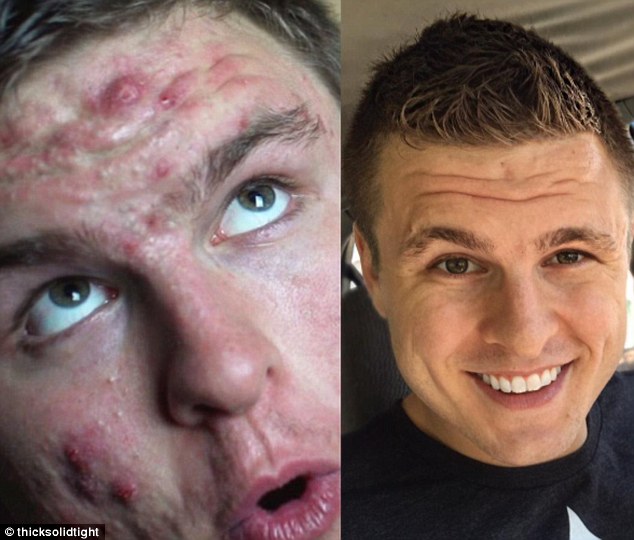acne cure vegan