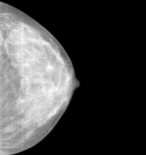 Mammogram Alternatives Can Also Be Dangerous (And Often Are)