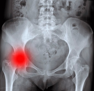 8 Natural Remedies to Help Heal After a Hip Fracture