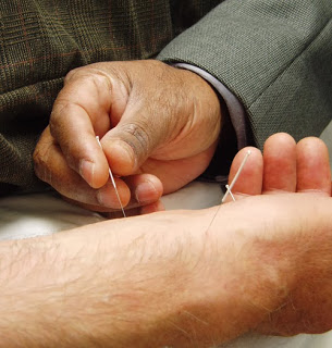 Study: Acupuncture Can Treat Alzheimer’s Disease