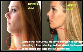 Woman Shrinks Inoperable Mass, Heals Thyroid Disease With Cannabis Oil
