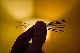 Acupuncture holds promise for treating inflammatory disease