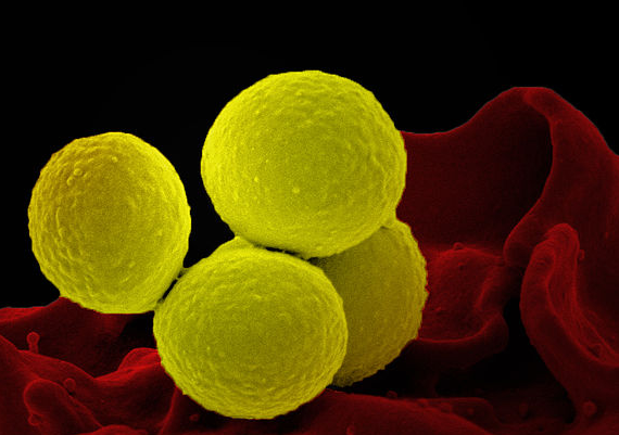 New MRSA Superbug Emerges in Brazil