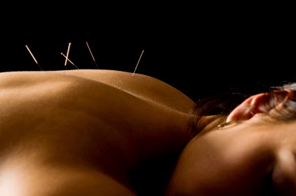 Bothered by hot flashes? Acupuncture might be the answer
