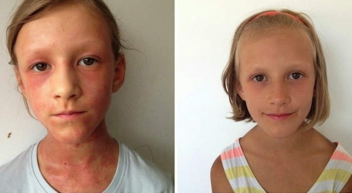 How A Mother Cured Her Daughter’s Eczema With A Raw Diet
