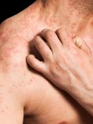 Medical Bills Another Burden for Eczema Patients: Study