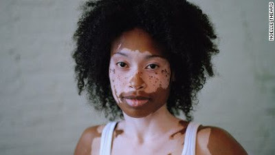 Healing Vitiligo with Ancient Health Wisdom – Chinese Medicine