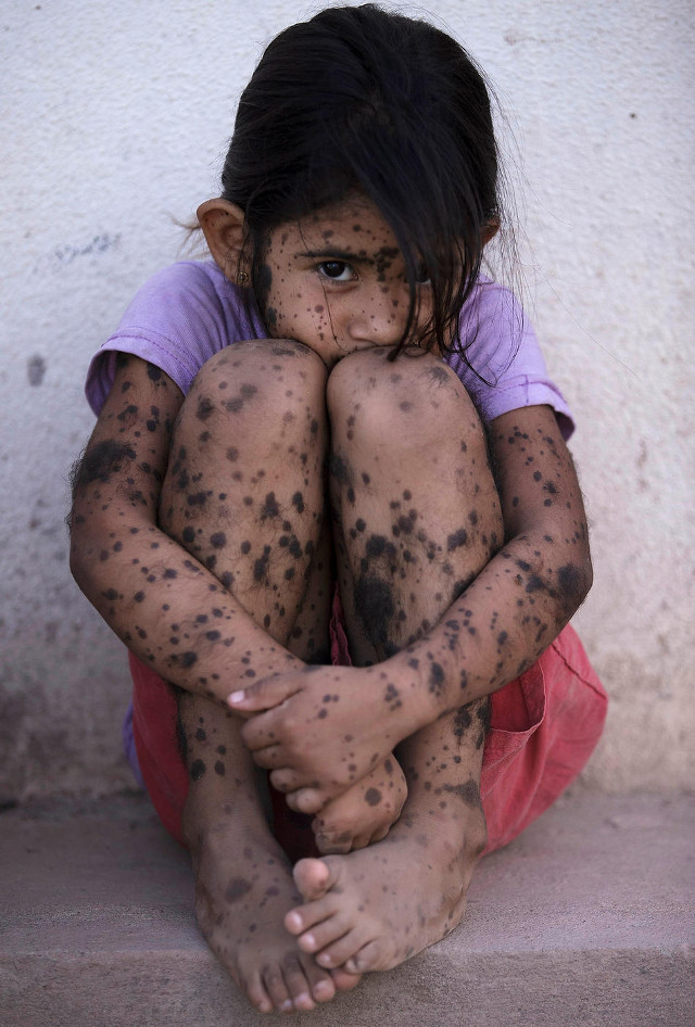 Aixa Cano, 5, who has hairy moles all over her body, sits on a stoop outside her home in Avia Terai, in Chaco province, Argentina, April 1, 2013. Doctors say Aixa’s birth defect may be linked to agrochemicals, although this cannot be proven. In Chaco, children are four times more likely to be born with devastating birth defects since the biotechnology boom. CREDIT: Natacha Pisarenko/AP