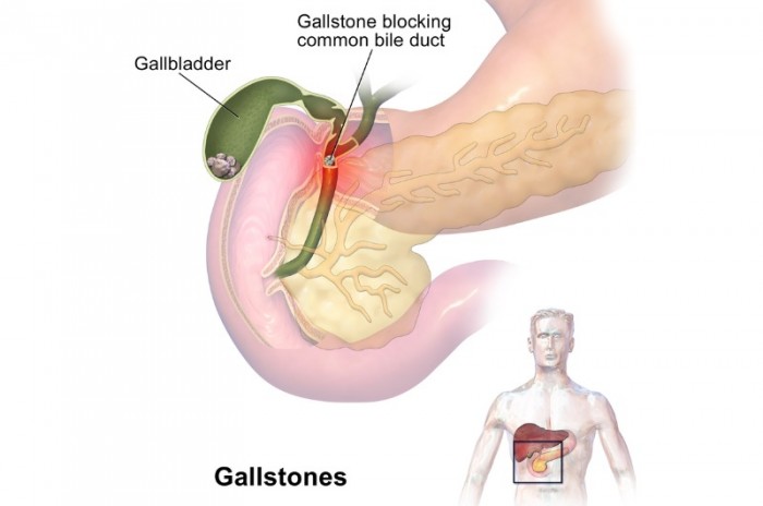 Pancreatitis often caused by gallstones: statins increase risk