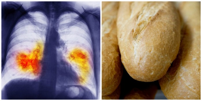 Study: Eating White Bread & Bagels Can Be Worse than Smoking – 49% Increase in Lung Cancer