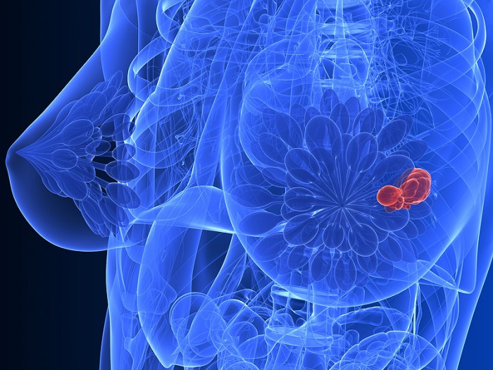 Women Nearly 3 Times Likely To Get Breast Cancer With Common Hormone Replacement Therapies