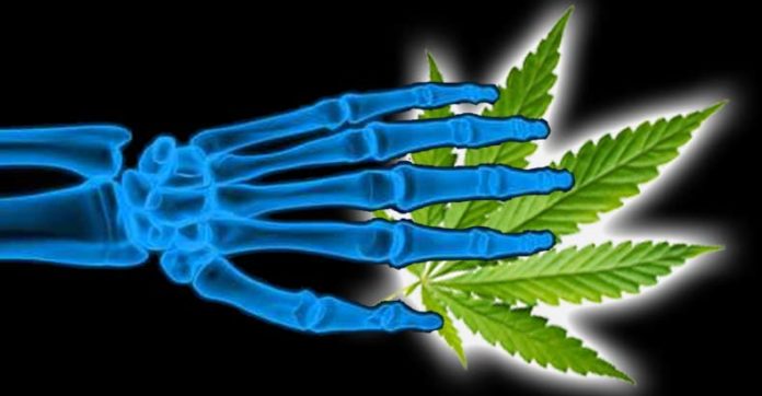 New Studies Confirm Marijuana Heals Broken Bones and Prevents Rejection of Transplanted Organs