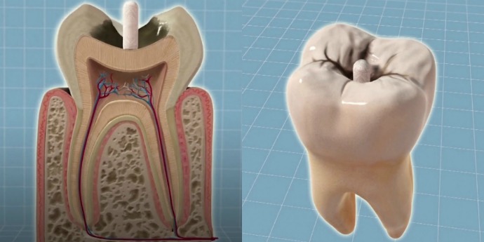 End of Fillings? King’s Researchers Find Novel Way to Regrow Damaged Teeth
