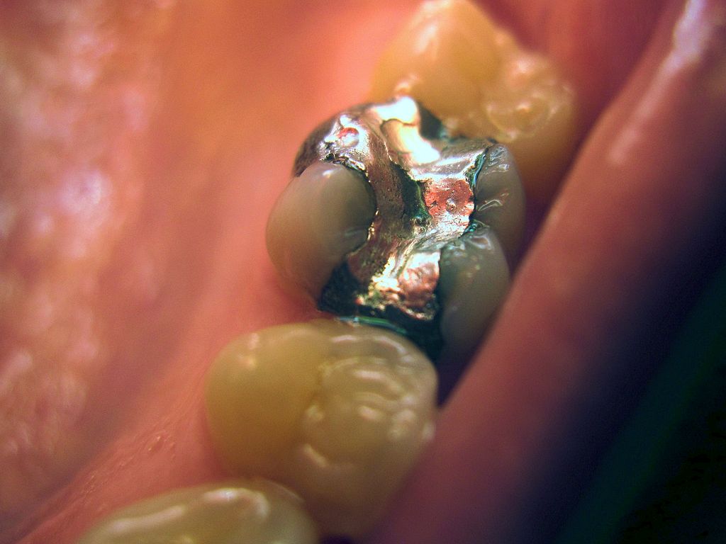 mercury dental amalgams