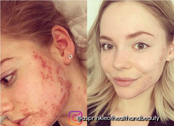 Beauty Queen Healed Her Cystic Acne With Simple Diet Change