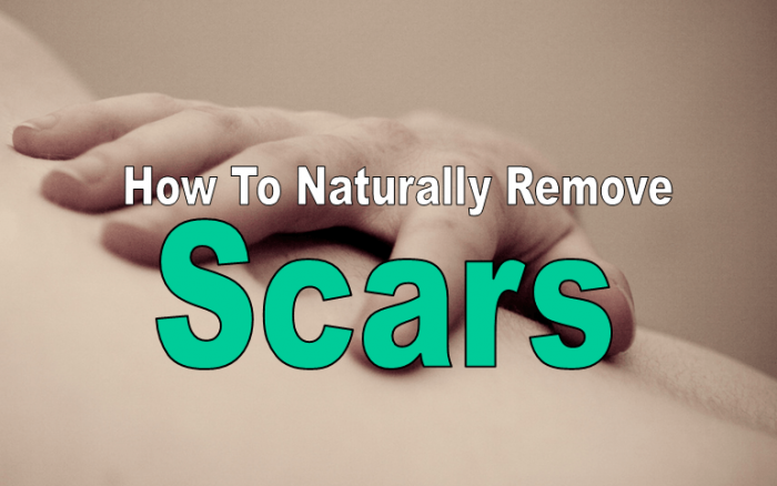 Remove Scars Naturally With These 9 Remedies 