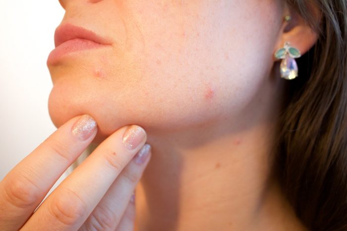 The Best Acne Treatment That Works Fast