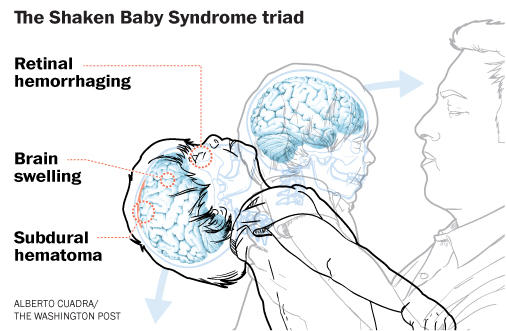 When Dogma Destroys Deduction: Retinal Bleeding, Shaken Baby Syndrome and Vaccines