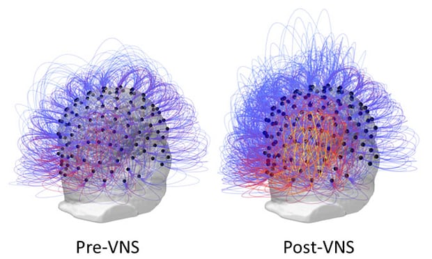 Man Responds After 15 Year Vegetative State Following Nerve Implant