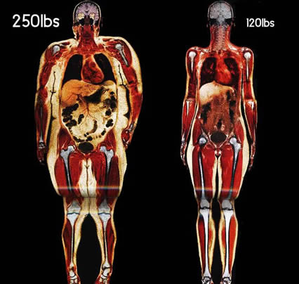 Not The Amount, But Where Your Fat Is Stored Critical For Heart Attack, Stroke and Diabetes Risk