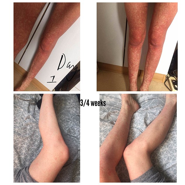 She Healed Psoriasis With This Diet After She Was Offered CHEMO for Her Skin Psoriasis-diet-2