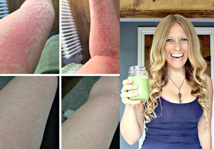 She Healed Psoriasis With This Diet After She Was Offered CHEMO for Her Skin