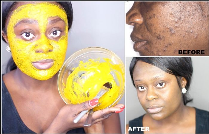 This DIY Turmeric Mask Clears Skin and More