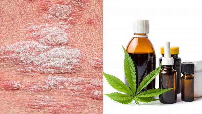 Could Cannabis CBD Cure Psoriasis and Eczema?