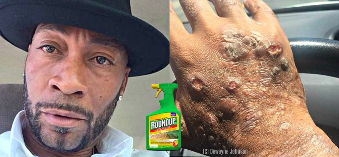 Dying Man’s Lawsuit Claims Monsanto Hid The Cancer Dangers Of Roundup For Years