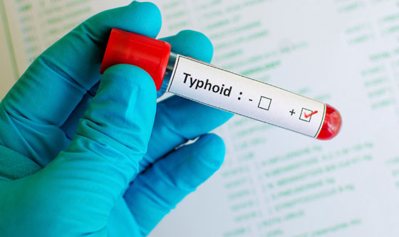 Flea-Borne Typhus Has Reached “Epidemic Levels” in Los Angeles