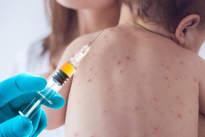 Government Research Confirms Measles Outbreaks are Transmitted by the Vaccinated