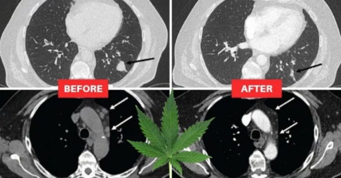 Lung Cancer Patient’s Tumors Shrunk in Half After Using CBD Oil