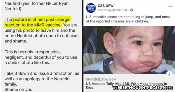 Mom Catches CBS Using Image of Her Vaccine-Injured Child, Falsely Claiming Measles Caused It