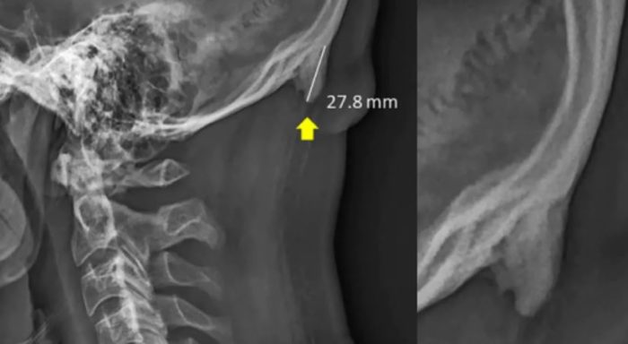 New Research: Young People Are Growing Bone Spur “Horns” From Smartphone Use