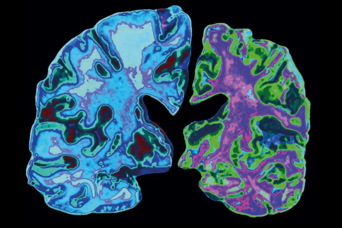 Microdsoing LSD Proves Safe For For Alzheimer’s Disease So Far After Phase 1 Clinical Trial