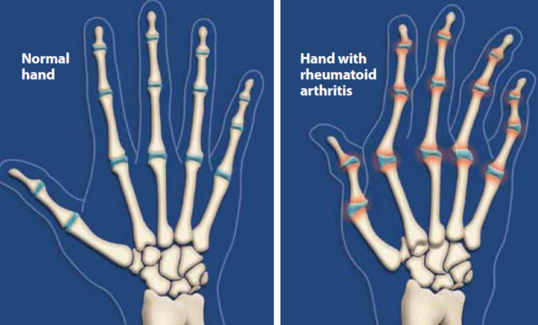 Brote artritis reumatoide