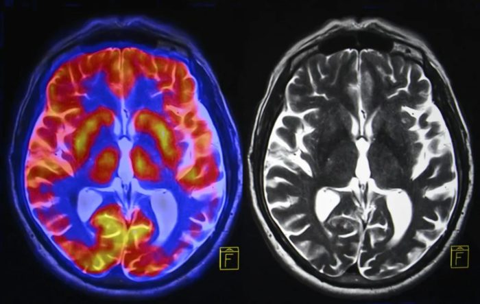 How Chronic Stress Changes The Brain – And What You Can Do To Reverse The Damage