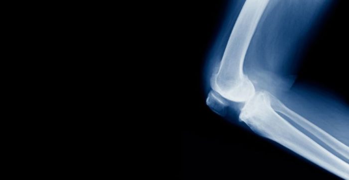 Taking Bone Meds? They Increase Your Risk of This Type of Fracture