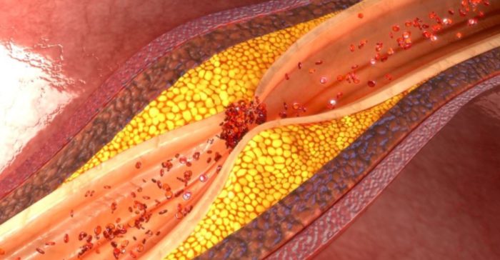 How to Clean Your Arteries With One Simple Fruit