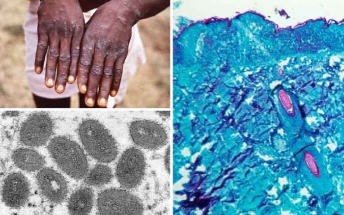 WHO Convenes Emergency Meeting As Monkeypox Virus Goes Global