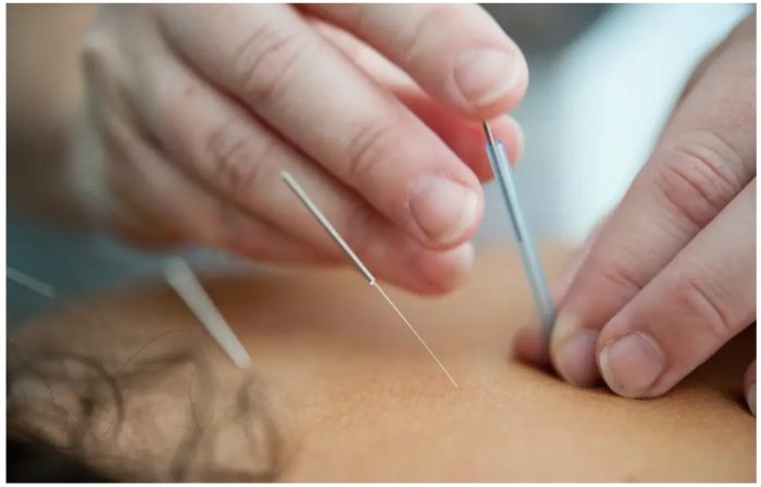 Acupuncture Can Relieve Lower Back and Pelvic Pain During Pregnancy