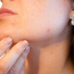 Popular Acne Products Like Clearasil And Proactiv Found To Contain Cancer-Causing Benzene