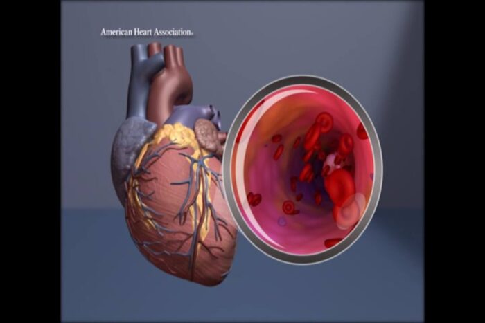 Heart Surgeons Find 58% of Patients Have Plastic Clogging Arteries